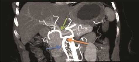 Assessment of Celiac Axis and Hepatic Artery Variations in ...