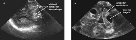 US images of the posterior fossa obtained through the mastoid ...