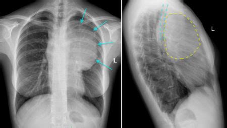 Anterior mediastinal mass - Radiology at St. Vincent's University Hospital