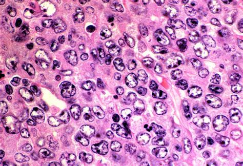 Diffuse Large B-cell Lymphoma (DLBCL) | Flow Cytometry