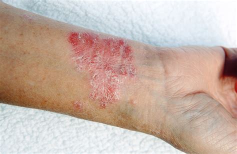 Psoriatic Arthritis Symptoms & Pictures