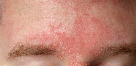 Skin Conditions/Dermatitis | Acne Concern