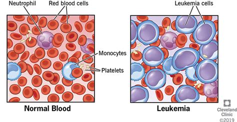 Leukemia: Symptoms, Signs, Causes, Types & Treatment