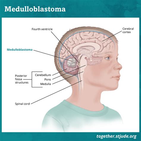 Posterior Fossa Craniotomy