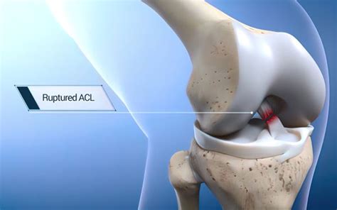 Understanding ACL Injuries: Causes, Symptoms, Treatment, and Prevention ...