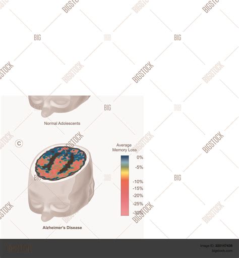 Brain Pet Scans. When Vector & Photo (Free Trial) | Bigstock