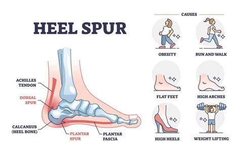 Heel Spur Treatment by a Physical Therapist including Exercises