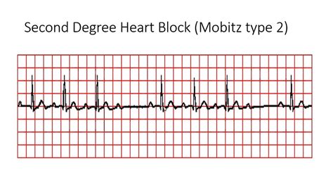 Second Degree Heart Block (Mobitz type 2) - YouTube