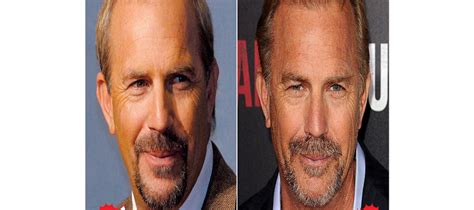 Kevin Costner Hair Transplant | Sapphire Hair Clinic