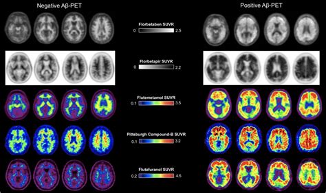 The Role of Amyloid PET in Imaging Neurodegenerative Disorders: A ...