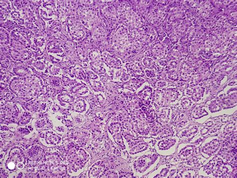 EPITHELIAL MALIGNANT MESOTHELIOMA – Histopathology.guru