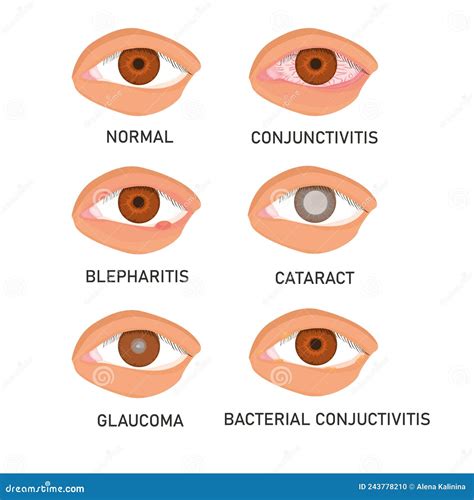 Set Of The Most Common Eye Diseases Isolated Stock Vector Free Download ...