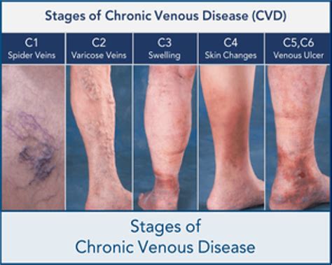 Venous Access Procedures | Pacific Vascular Institute