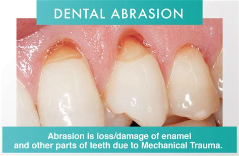 Dental Erosion and Dental Abrasion - 32 Smile Design – Schofields Dentistry