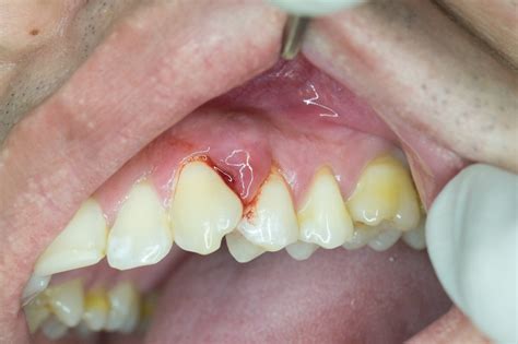 Gum Boil Causes, Types and Management