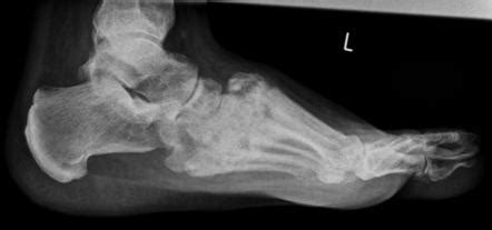 Charcot joint | Radiology Reference Article | Radiopaedia.org