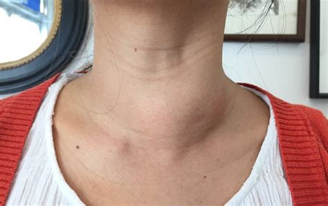 Multinodular Goiter: Symptoms, Diagnosis and Treatment - Scope Heal