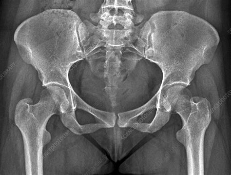 Female pelvis bones and joints, X-ray - Stock Image C033/7354 - Science ...