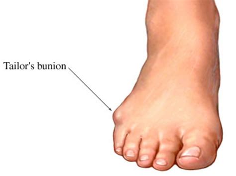 What is That Bump On the Outside of My Foot? Are You Suffering From a ...