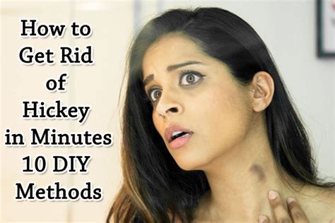 How to Get Rid of Hickey in Minutes – 10 DIY Methods