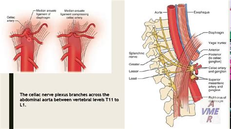 Median arcuate ligament syndrome ( MALS ) - YouTube