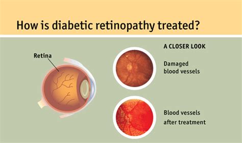 Lowering Blood Sugar: how to cure diabetic retinopathy treatment