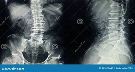 X-ray L-S Spine Scoliosis and Loss Lordosis Curve.Narrow L3-4-5 Disc ...