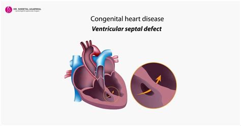 Congenital Heart Defect - Know What It Is and Save Your Unborn Child ...