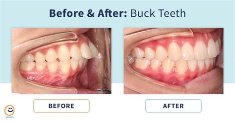 Braces: Before and After Buck Teeth