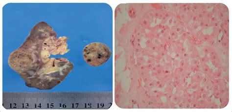 Renal oncocytoma in a kidney transplant patient: the imaging features ...