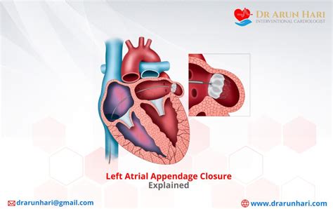 Left Atrial Appendage Closure Explained - Dr Arun Hari