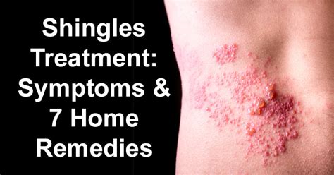 Shingles Treatment: Symptoms & 7 Home Remedies For Shingles - David ...