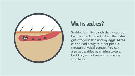 Scabies: What is, Symptoms, Treatment, Prevention, and Useful Facts ...