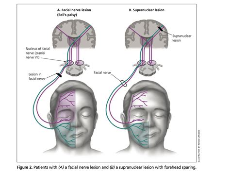 Cranial Nerve Lesion - IM Reference Internal Capsule, Nerve Palsy ...