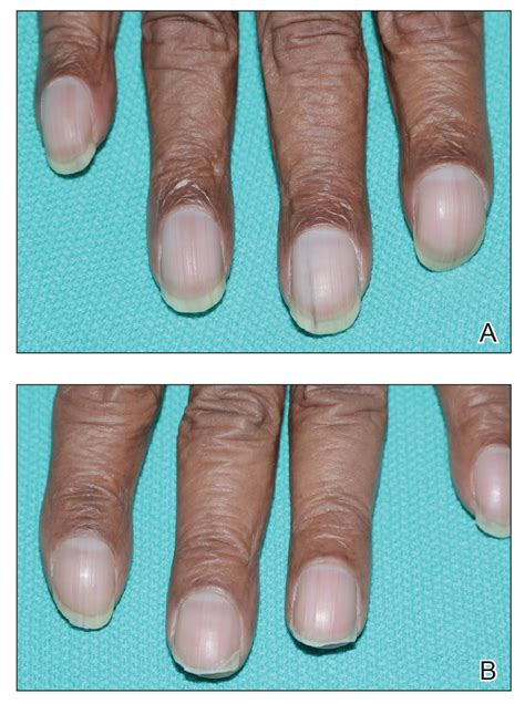 Unilateral Nail Clubbing in a Hemiparetic Patient | MDedge Dermatology