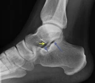 Subtalar Joint Arthritis: Causes, Symptoms, Diagnosis & Treatment