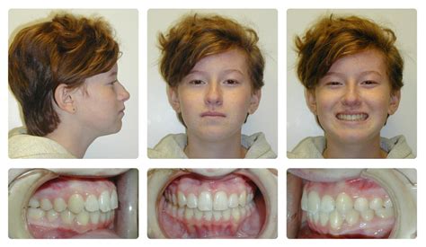 Orthodontic Before and After Photos | Brodsky Orthodontics