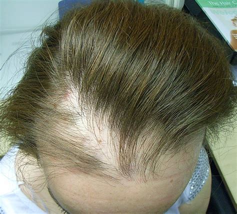 The Hair Loss Centre | More Photos of Female Hair Loss Treated Successfully