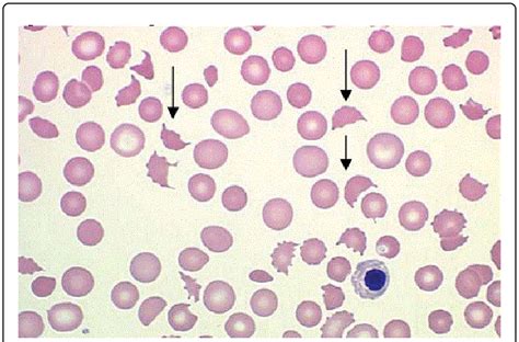 Hemolytic Anemia Blood Smear