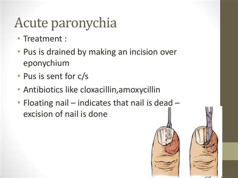 Paronychia