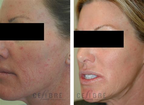 Rosacea Laser Treatment Before After Pictures 2