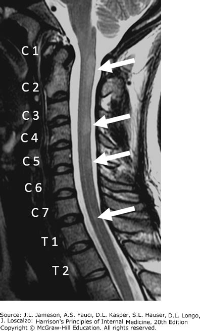 AccessMedicine's Image of the Week: Multiple Sclerosis of the Spinal ...