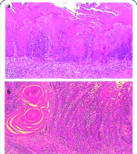 The histology of tongue (a) squamous cell carcinoma in situ and (b ...