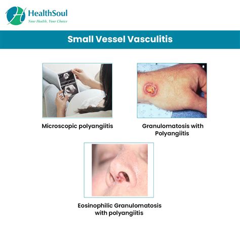 Vasculitis Symptoms