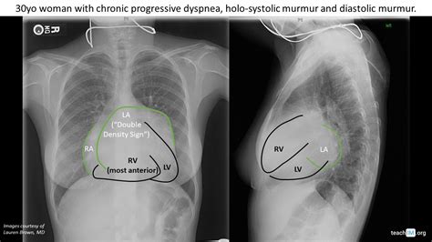 Cardiomegaly with Bi-atrial Enlargement | CXR | teachIM.org