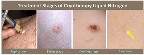 Cryosurgery Liquid Nitrogen in Plano, TX | Skin MD & Beyond