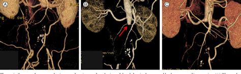 Figure 1 from Complete Revascularization of Juxtarenal Aortic Occlusion ...