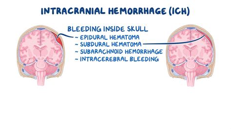 Epidural Hematoma (EDH): Symptoms, Causes Treatment, 51% OFF