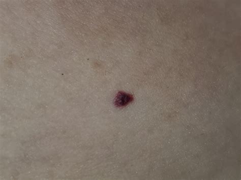 Can't tell if this is a small blood blister or something else. : r ...