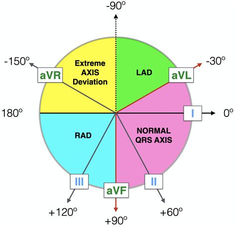 Left Axis Deviation (LAD) • LITFL • ECG Library Diagnosis